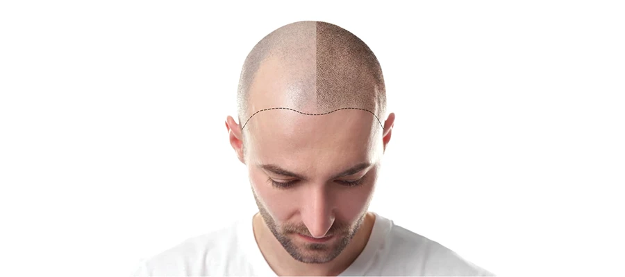 How Much Hair Grows Back by the 6th Month After a Hair Transplant?