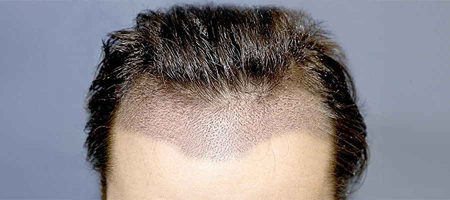 Unshaven Hair Transplant