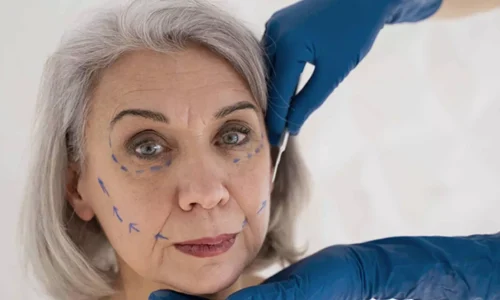 Endolift Nedir