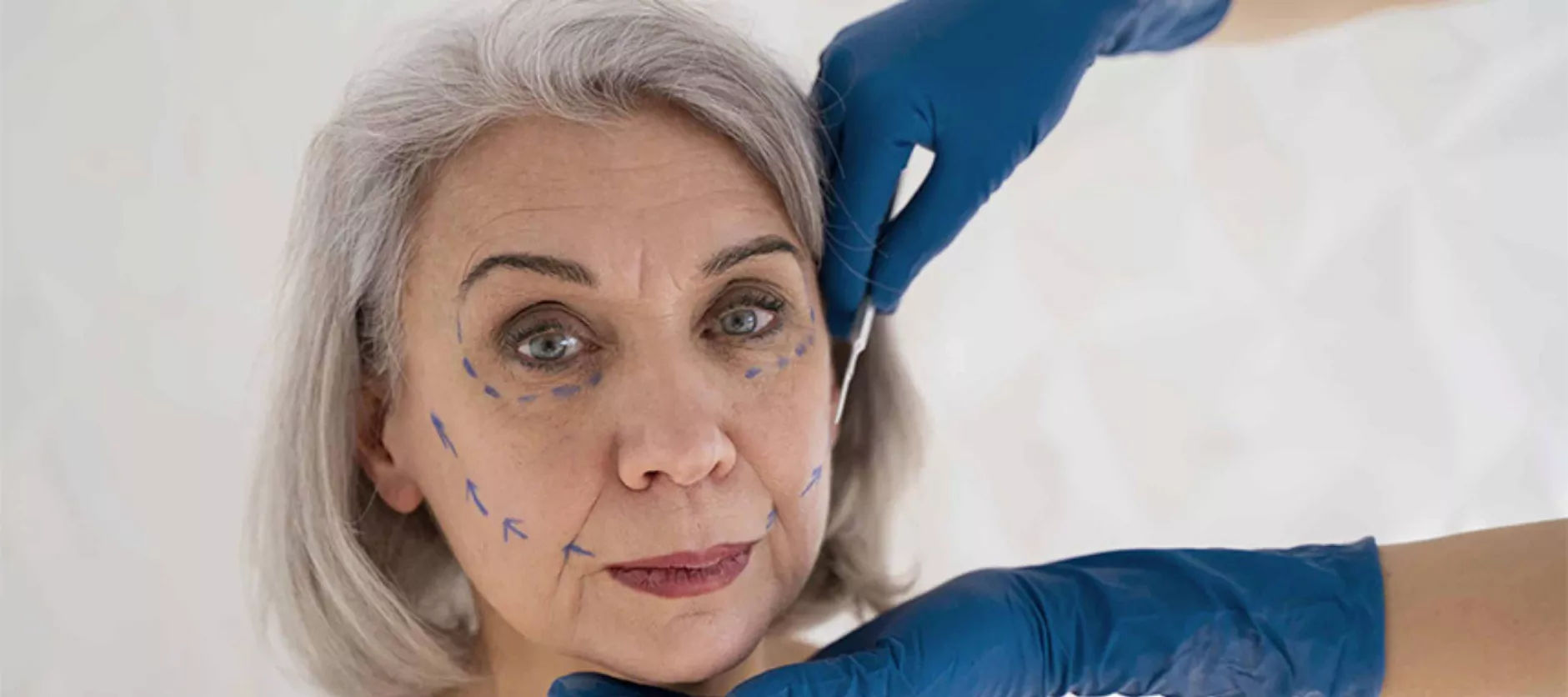 Endolift Nedir